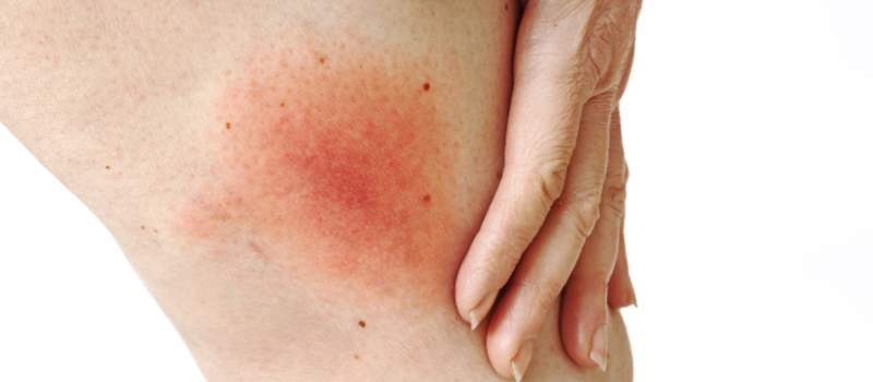 Adelaide's #1 Tick Treatment Services